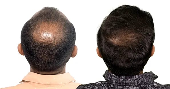 Mesotherapy (Targeted Scalp Nutrition)