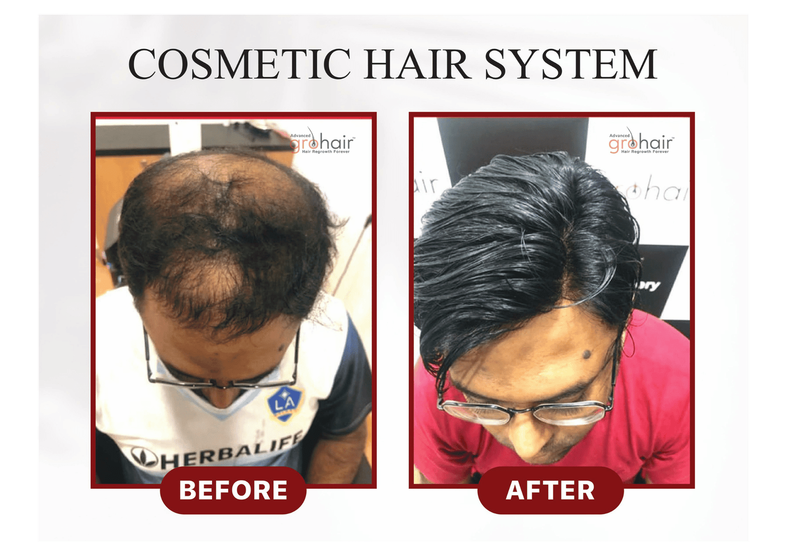 Before - Beard Transplant